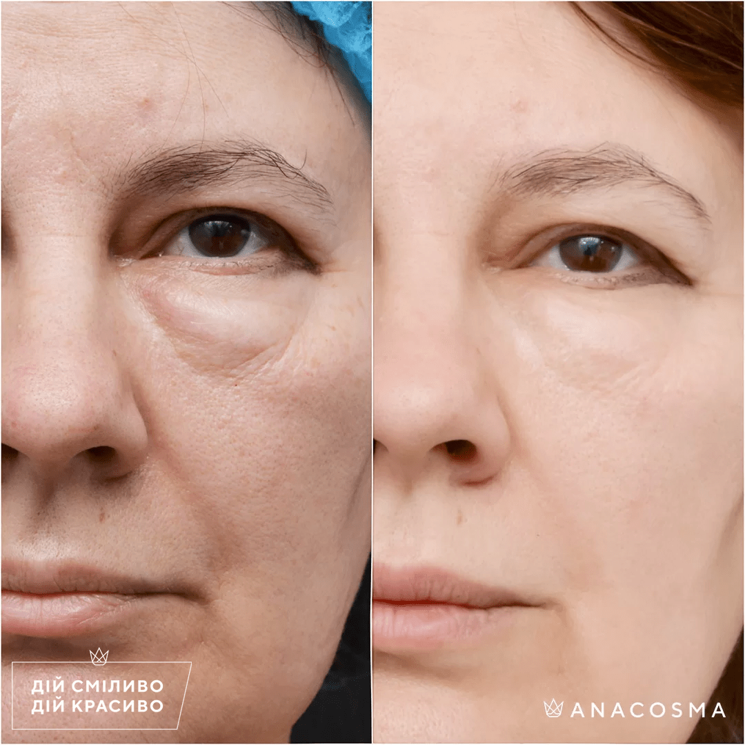 Наноліпофілінг (нанографтинг) до і після - Фото 1