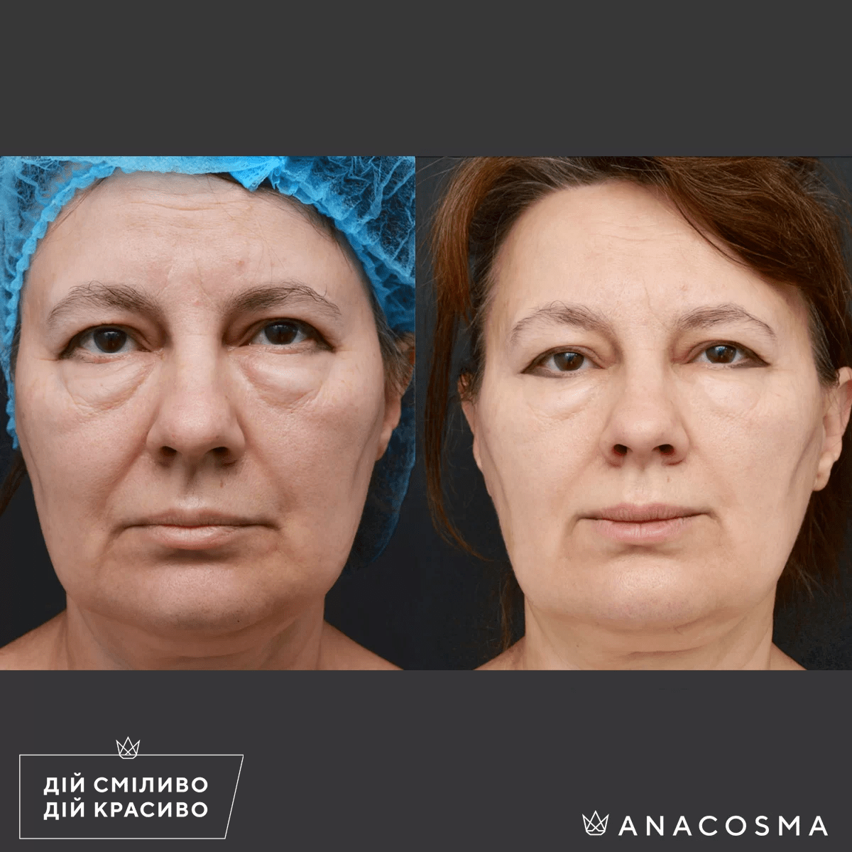 Наноліпофілінг (нанографтинг) до і після - Фото 3