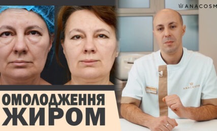НАНОЛІПОФІЛІНГ VS ЛІПОФІЛІНГ ОБЛИЧЧЯ: ОМОЛОДЖЕННЯ ЖИРОМ 💉🔥 ЩО КРАЩЕ?
