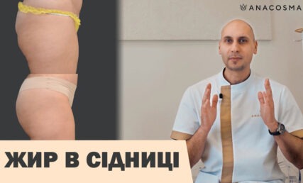 ЛІПОФІЛІНГ СІДНИЦЬ 🍑 ЗБІЛЬШЕННЯ СІДНИЦЬ ЖИРОМ