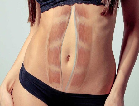 Діастаз прямих м’язів живота: причини та лікування | Анакосма Діастаз прямих м’язів живота: причини та лікування