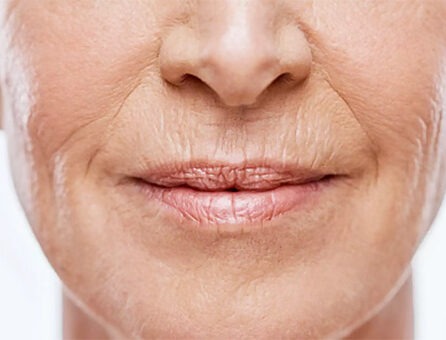 Як прибрати кисетні зморшки | Анакосма Як прибрати кисетні зморшки