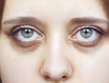 Як прибрати темні кола під очима | Анакосма Як прибрати темні кола під очима