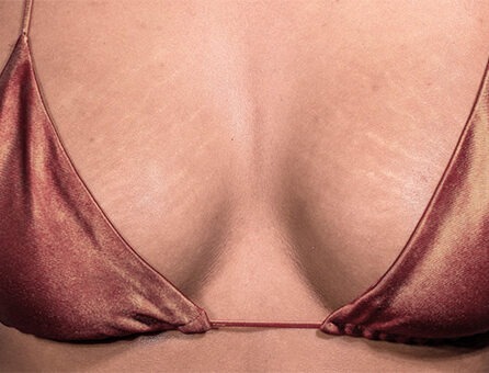 Розтяжки на грудях: причини та методи позбавлення | Анакосма Розтяжки на грудях: причини та методи позбавлення