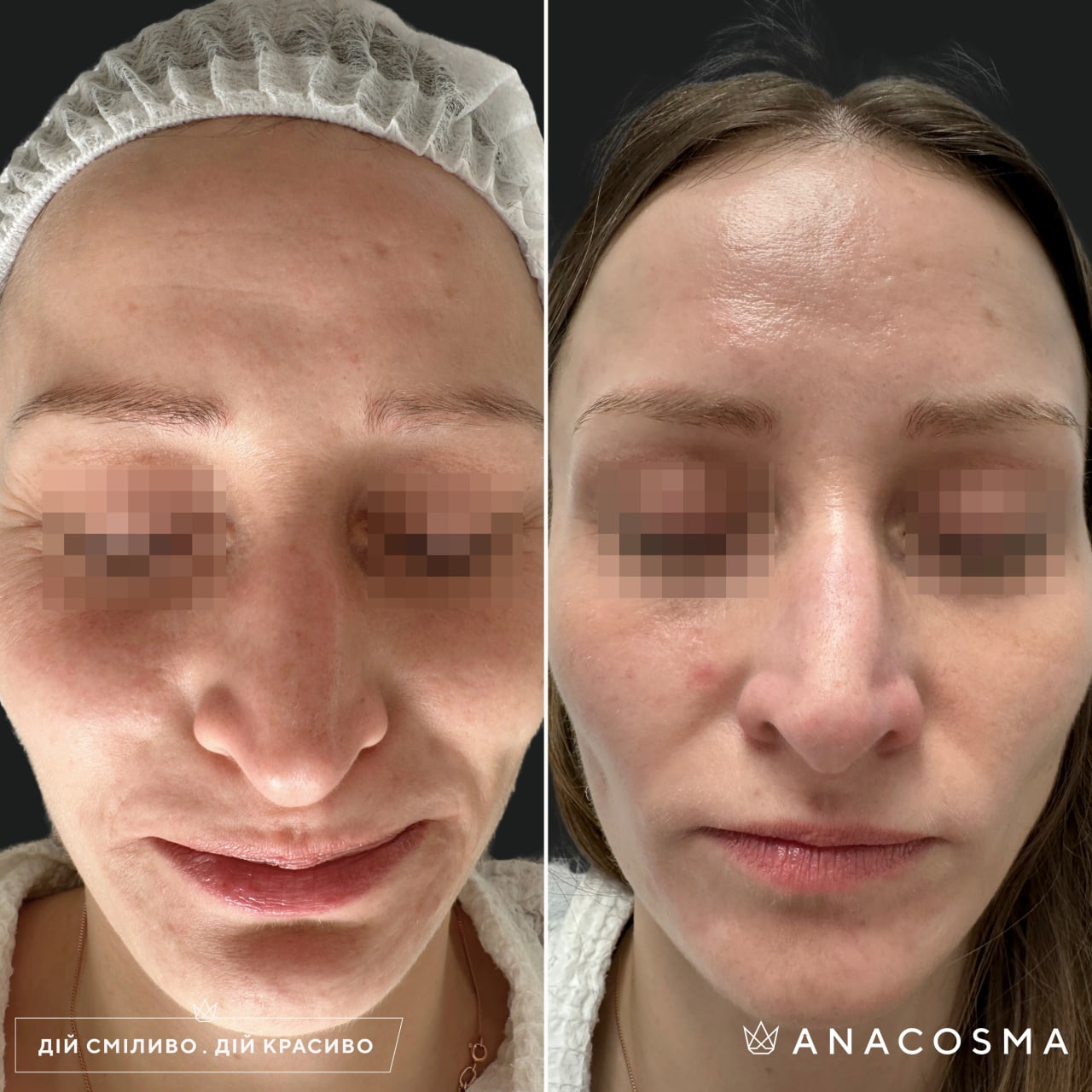 RF-ліфтинг Double Tite до і після - Фото 9