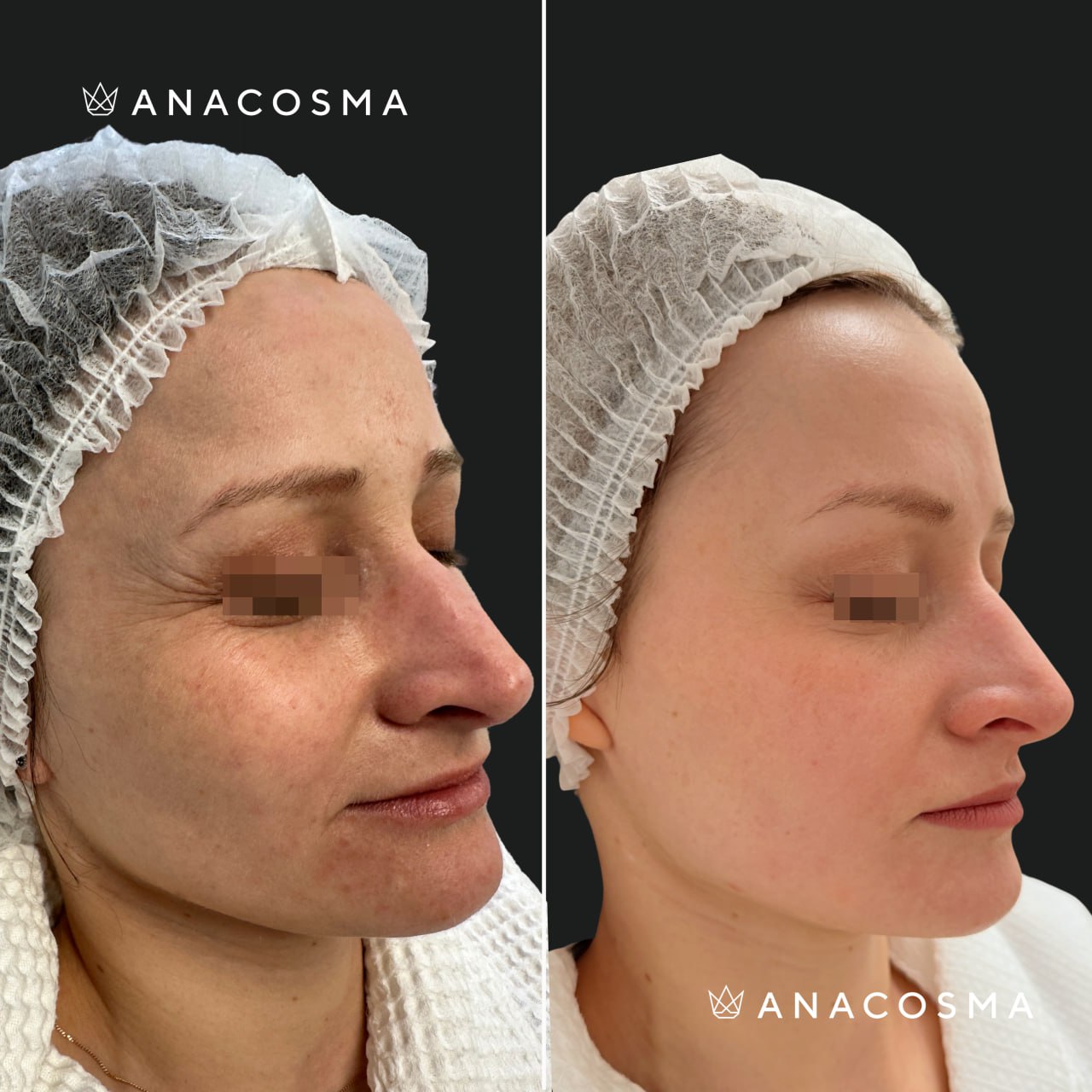 RF-ліфтинг Double Tite до і після - Фото 2