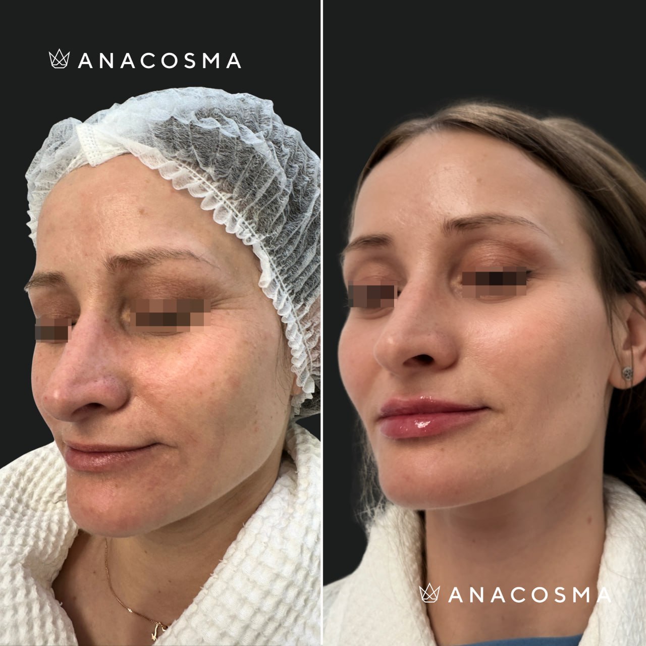 RF-ліфтинг Double Tite до і після - Фото 1