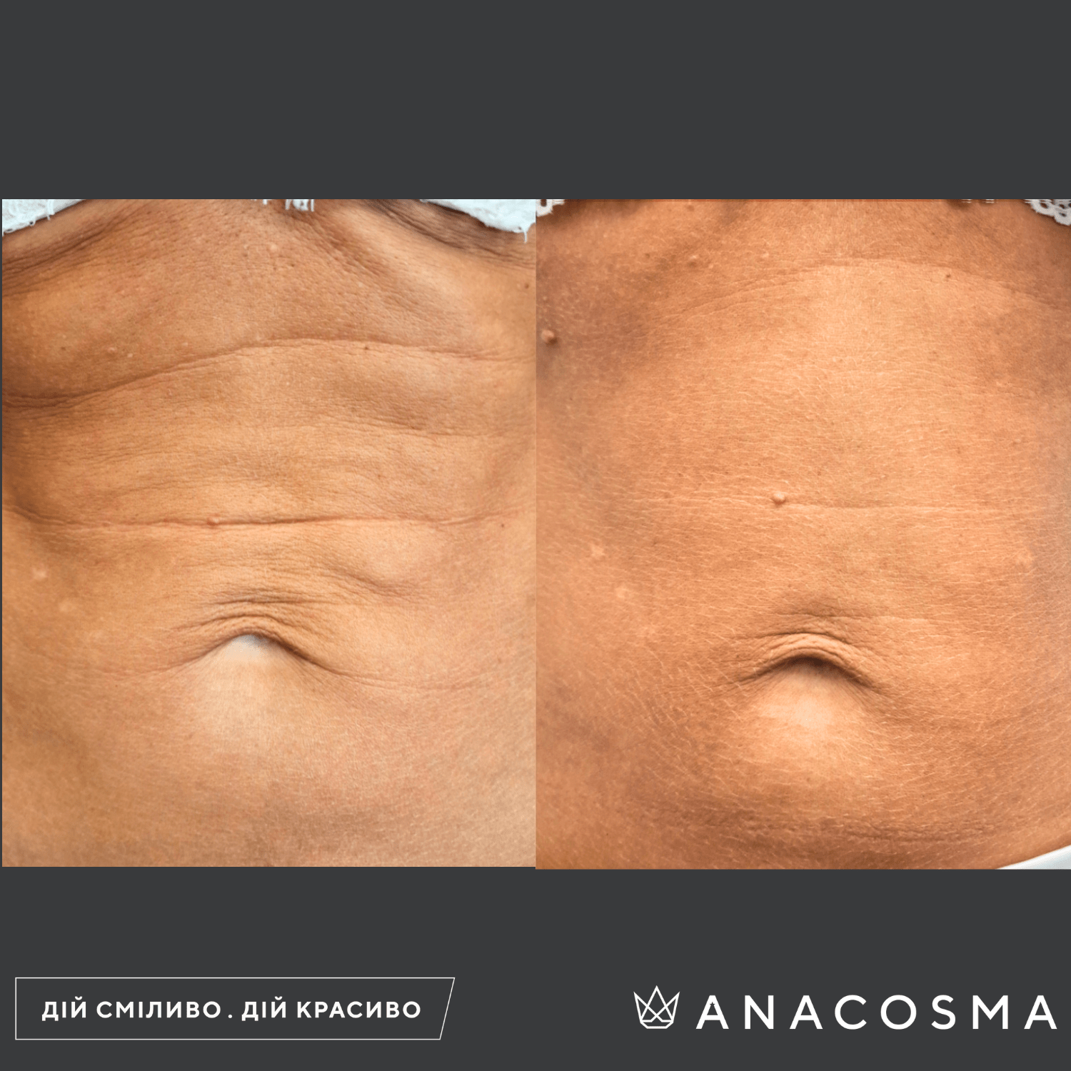 RF-ліфтинг Double Tite до і після - Фото 5