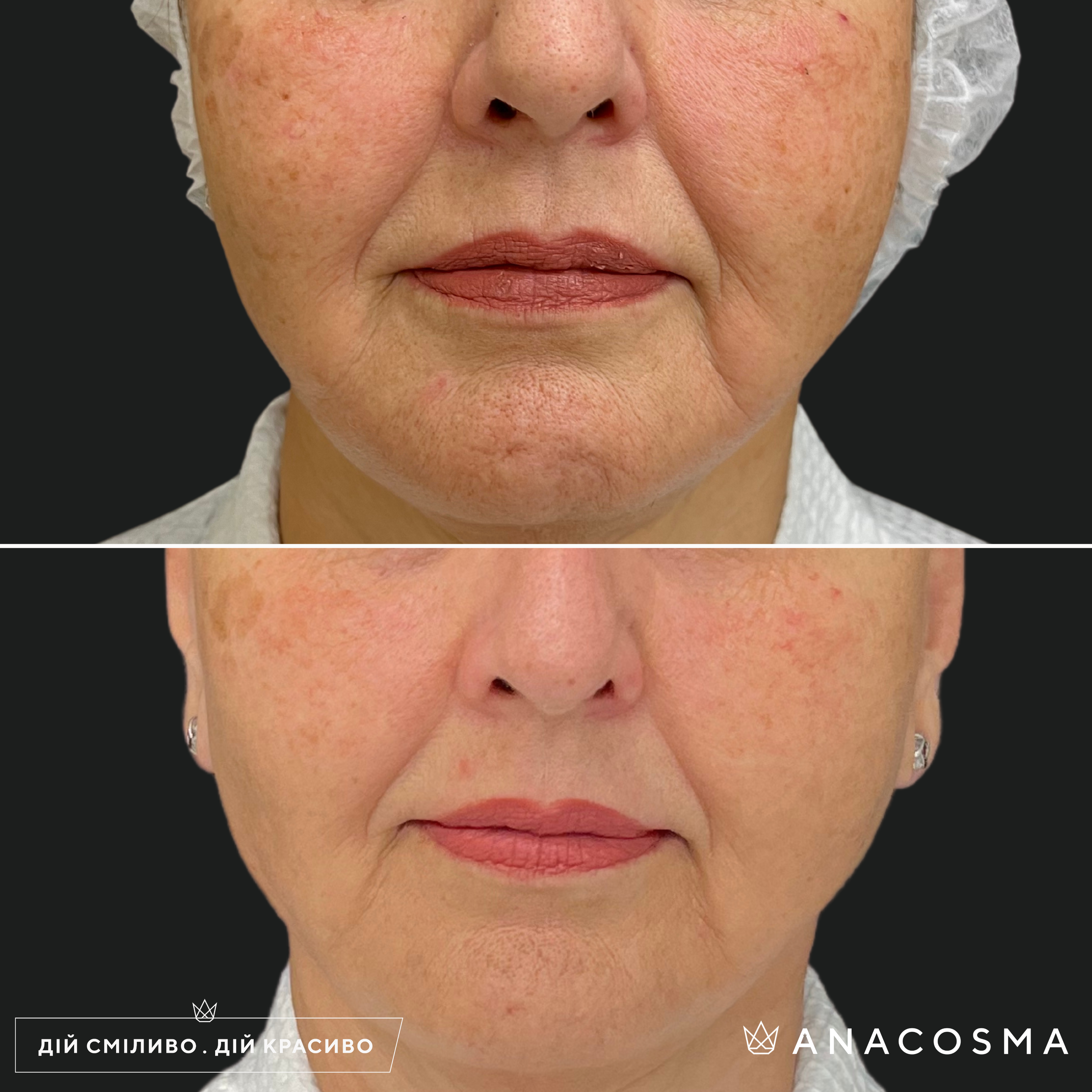 RF-ліфтинг Double Tite до і після - Фото 12