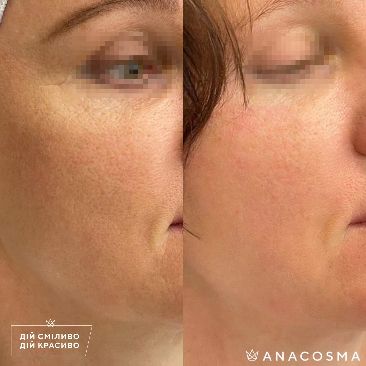 RF-ліфтинг Double Tite до і після - Фото 8