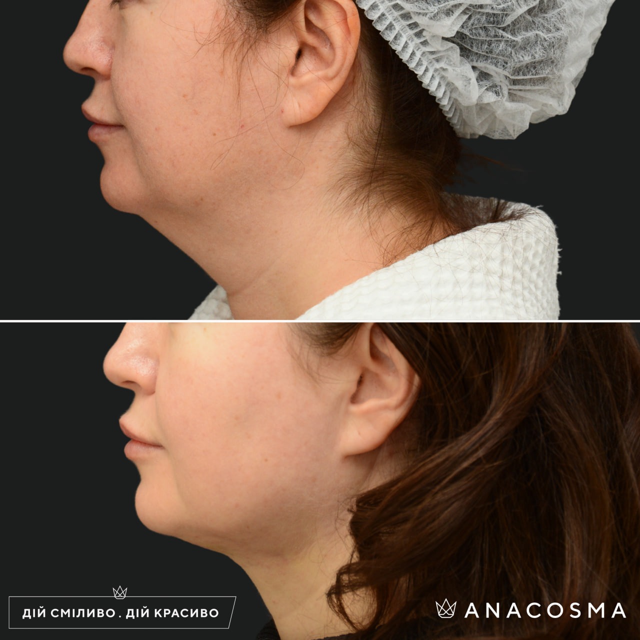 V-овал: чіткий кут молодості до і після - Фото 21