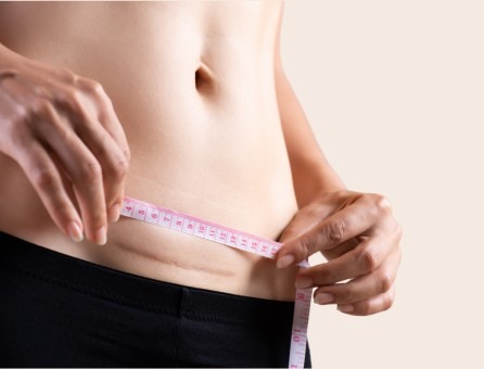 Позбавляємося шраму після кесаревого розтину: ефективні методи | Анакосма Позбавляємося шраму після кесаревого розтину: ефективні методи