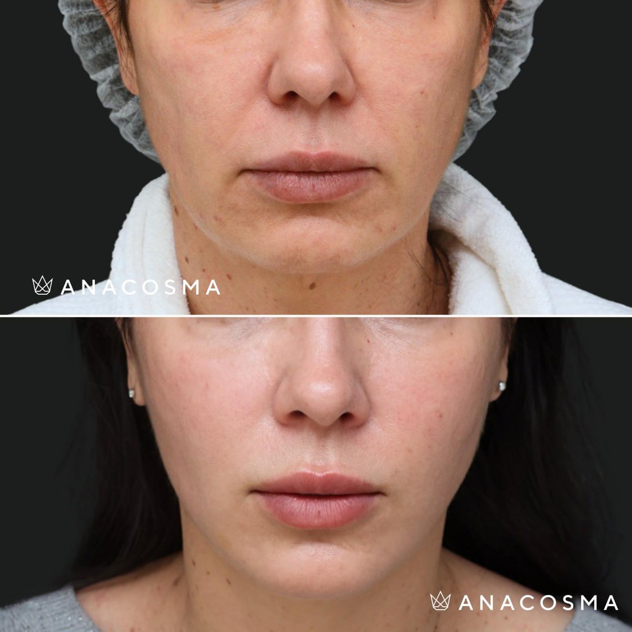 V-овал: чіткий кут молодості до і після - Фото 32