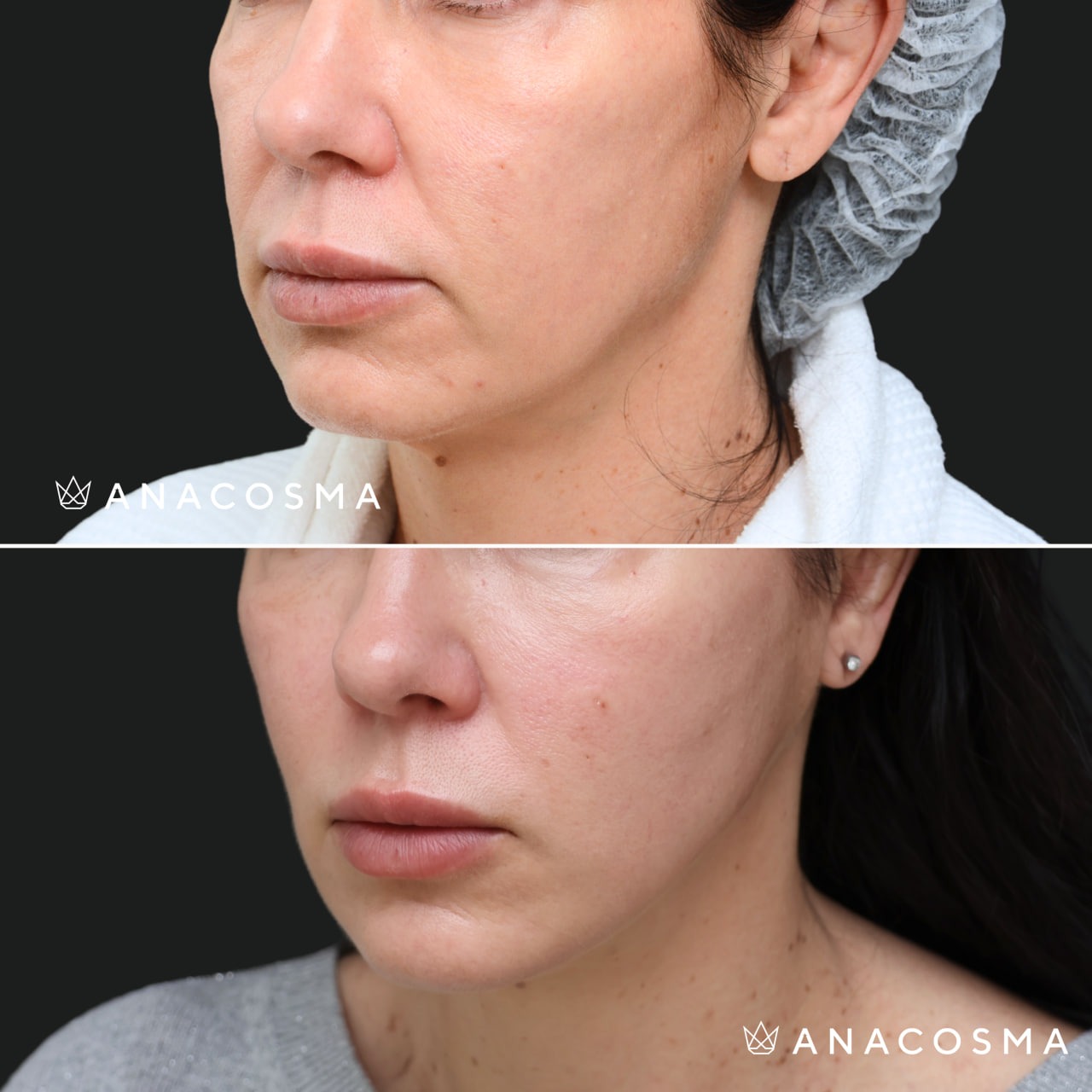 V-овал: чіткий кут молодості до і після - Фото 31