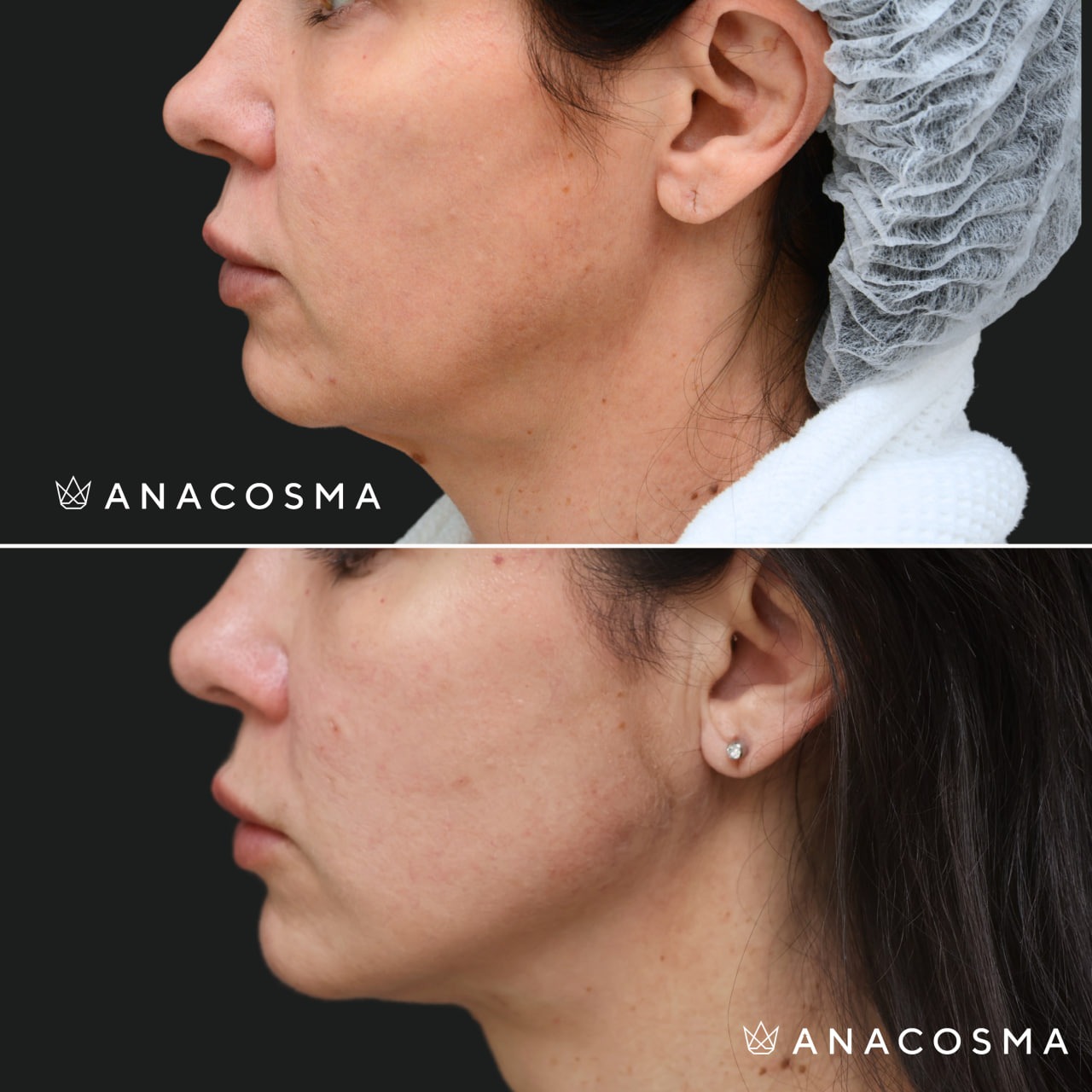 V-овал: чіткий кут молодості до і після - Фото 30