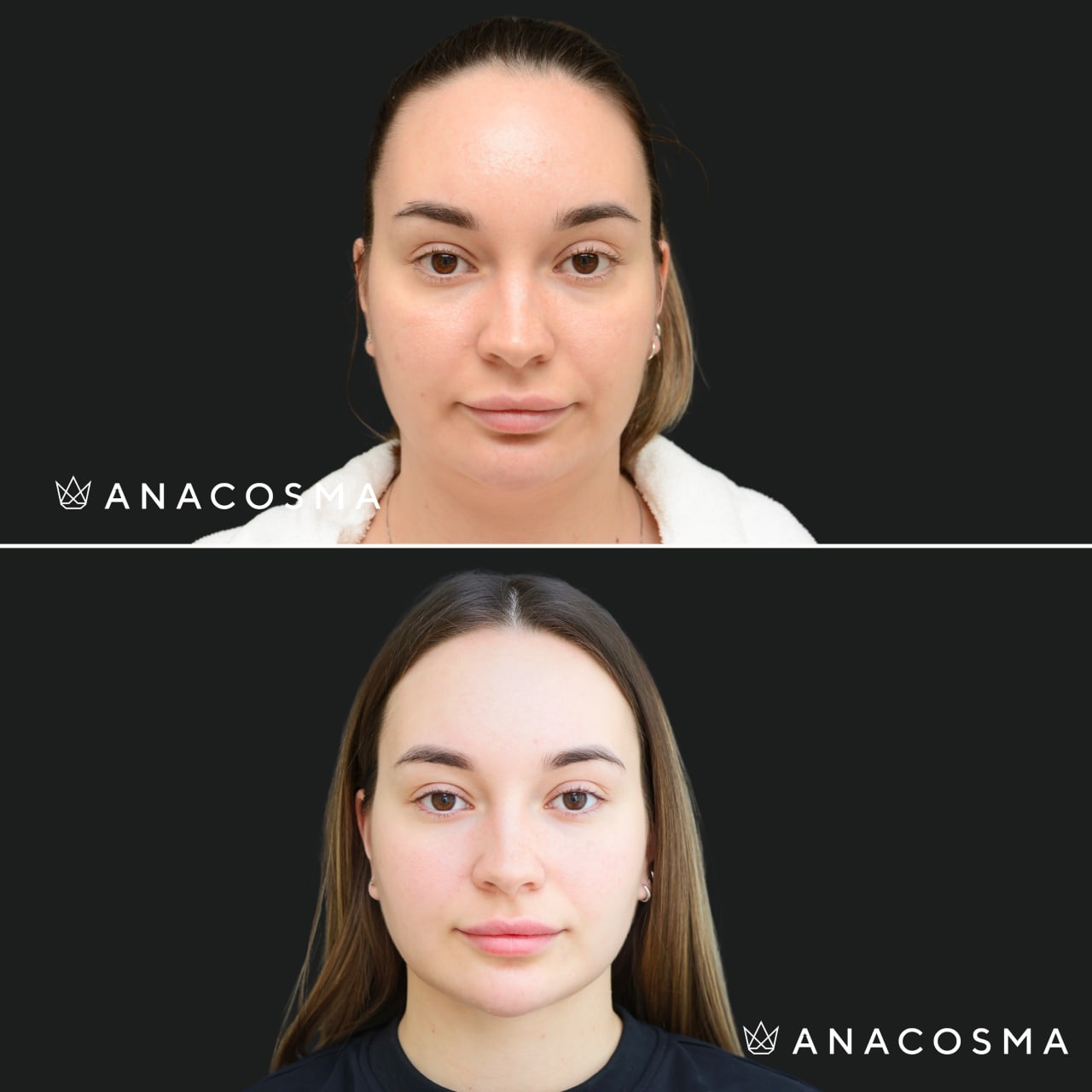 V-овал: чіткий кут молодості до і після - Фото 22