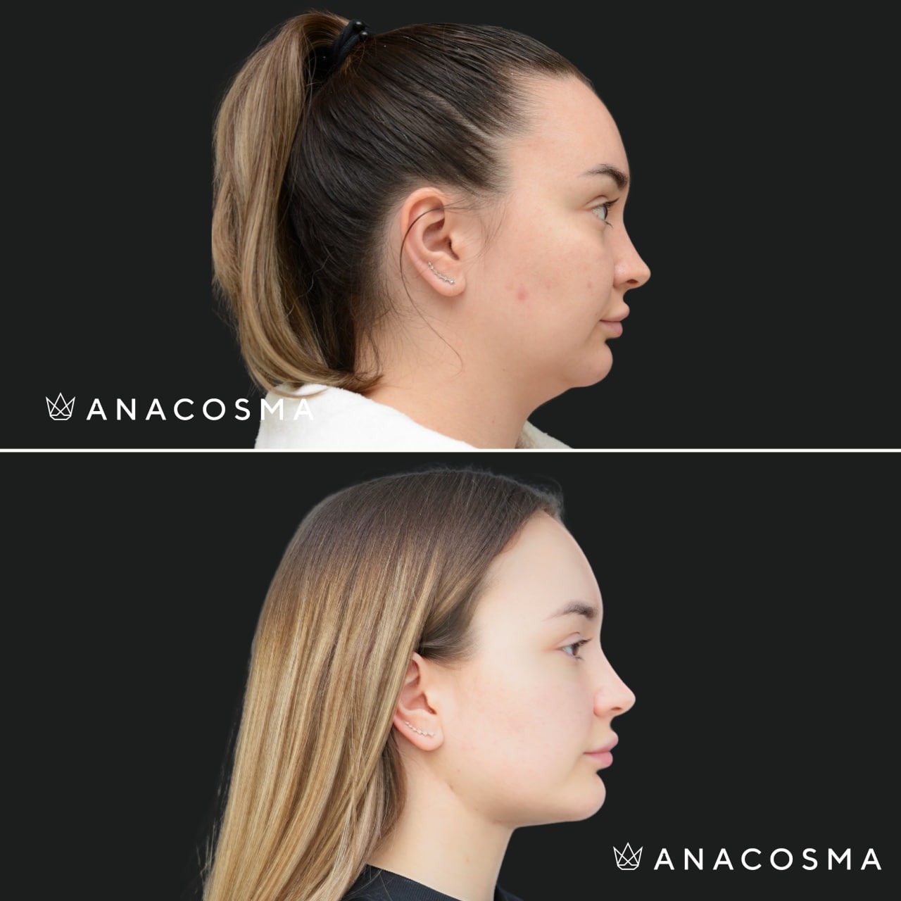 V-овал: чіткий кут молодості до і після - Фото 20