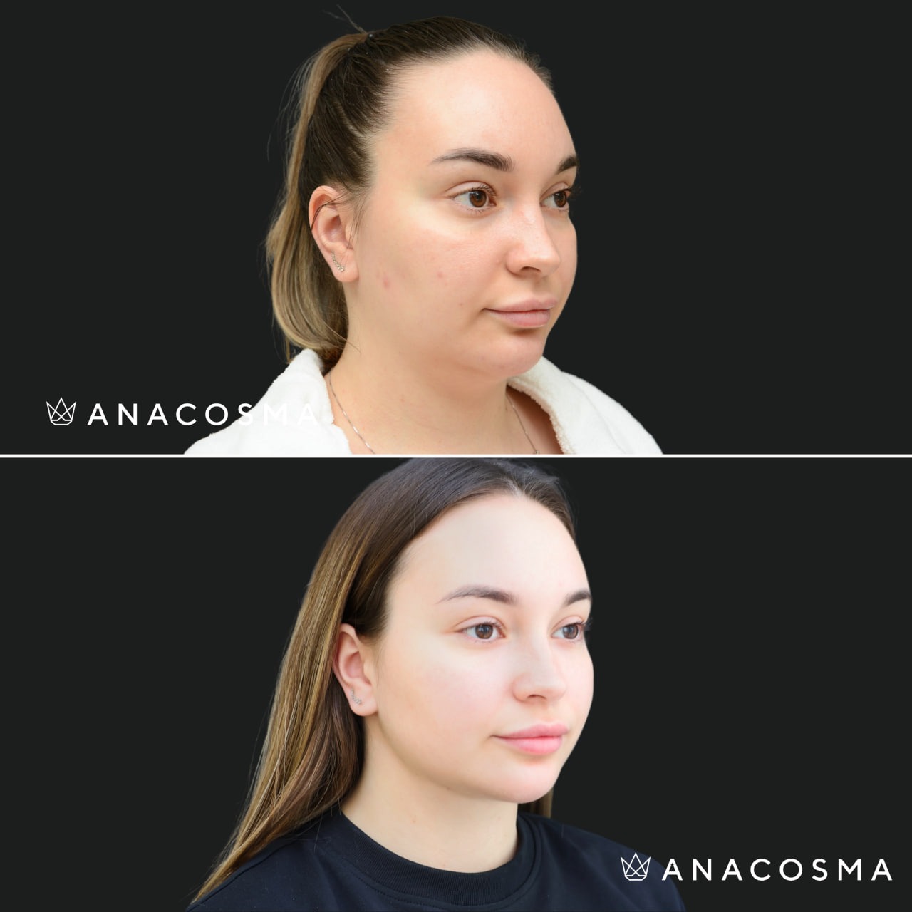 V-овал: чіткий кут молодості до і після - Фото 19