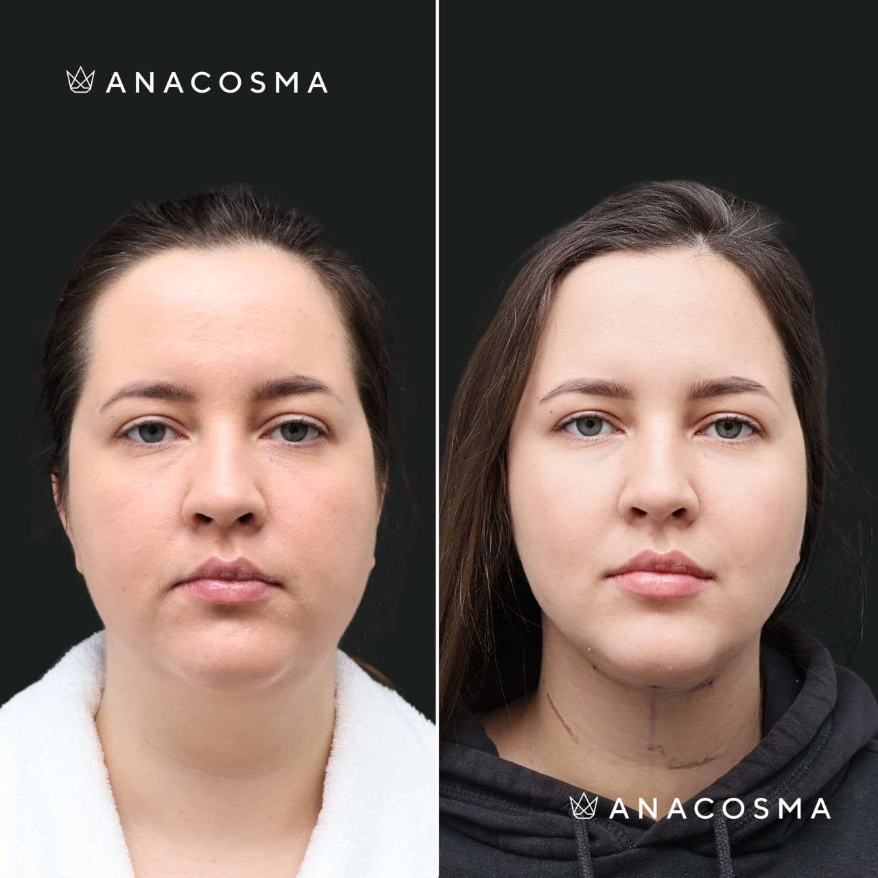 V-овал: чіткий кут молодості до і після - Фото 8