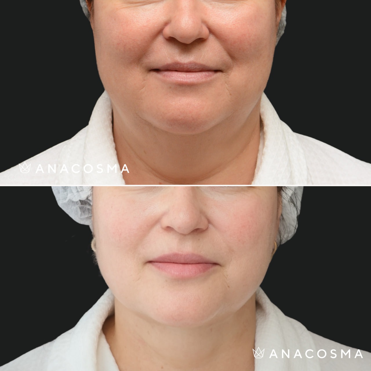 V-овал: чіткий кут молодості до і після - Фото 18