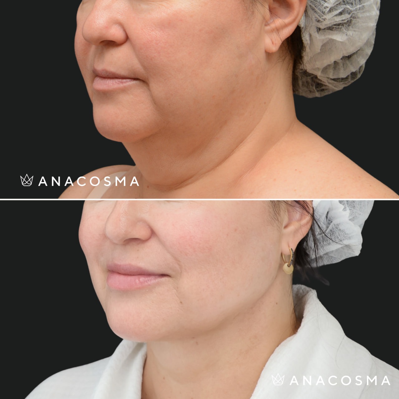 V-овал: чіткий кут молодості до і після - Фото 17