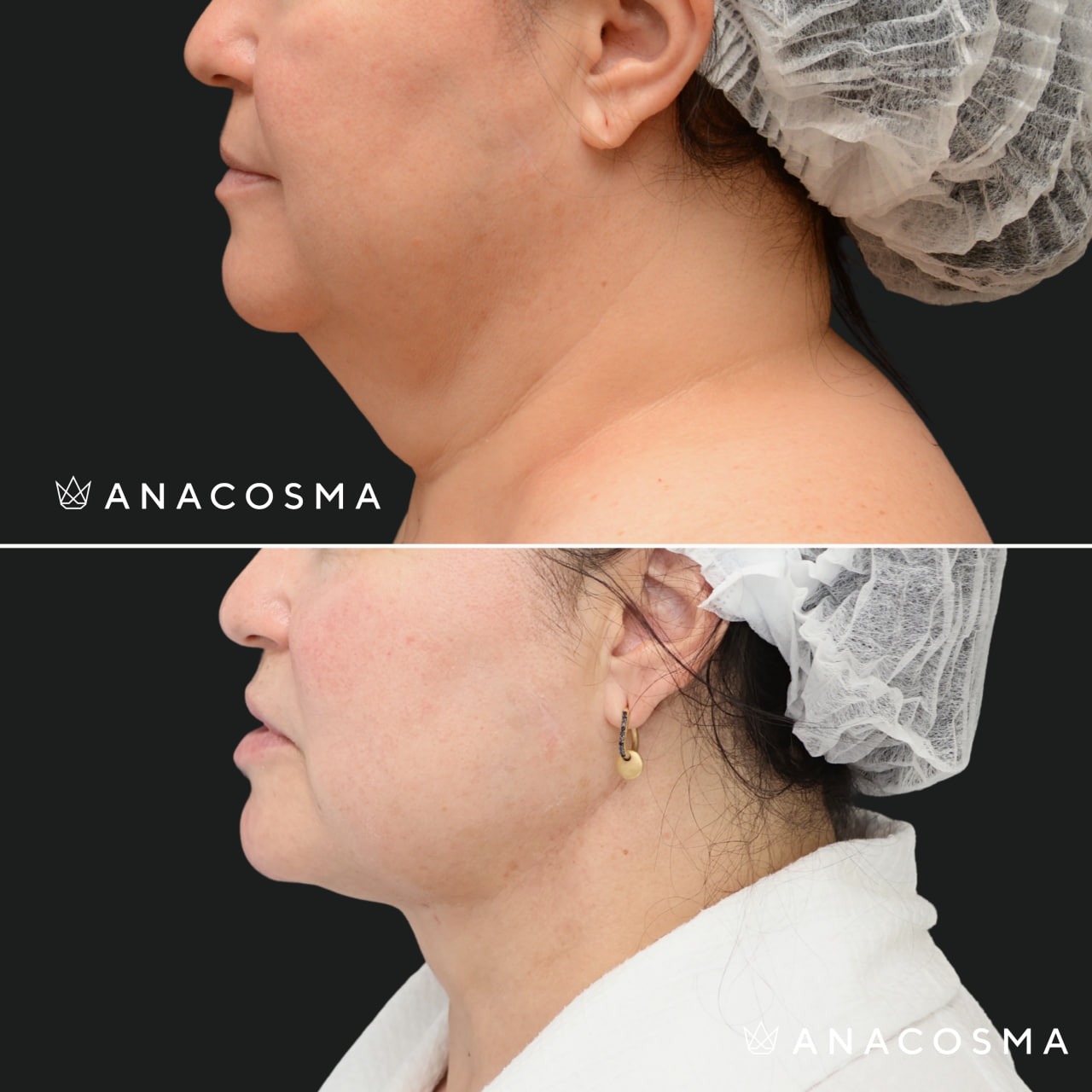 V-овал: чіткий кут молодості до і після - Фото 16