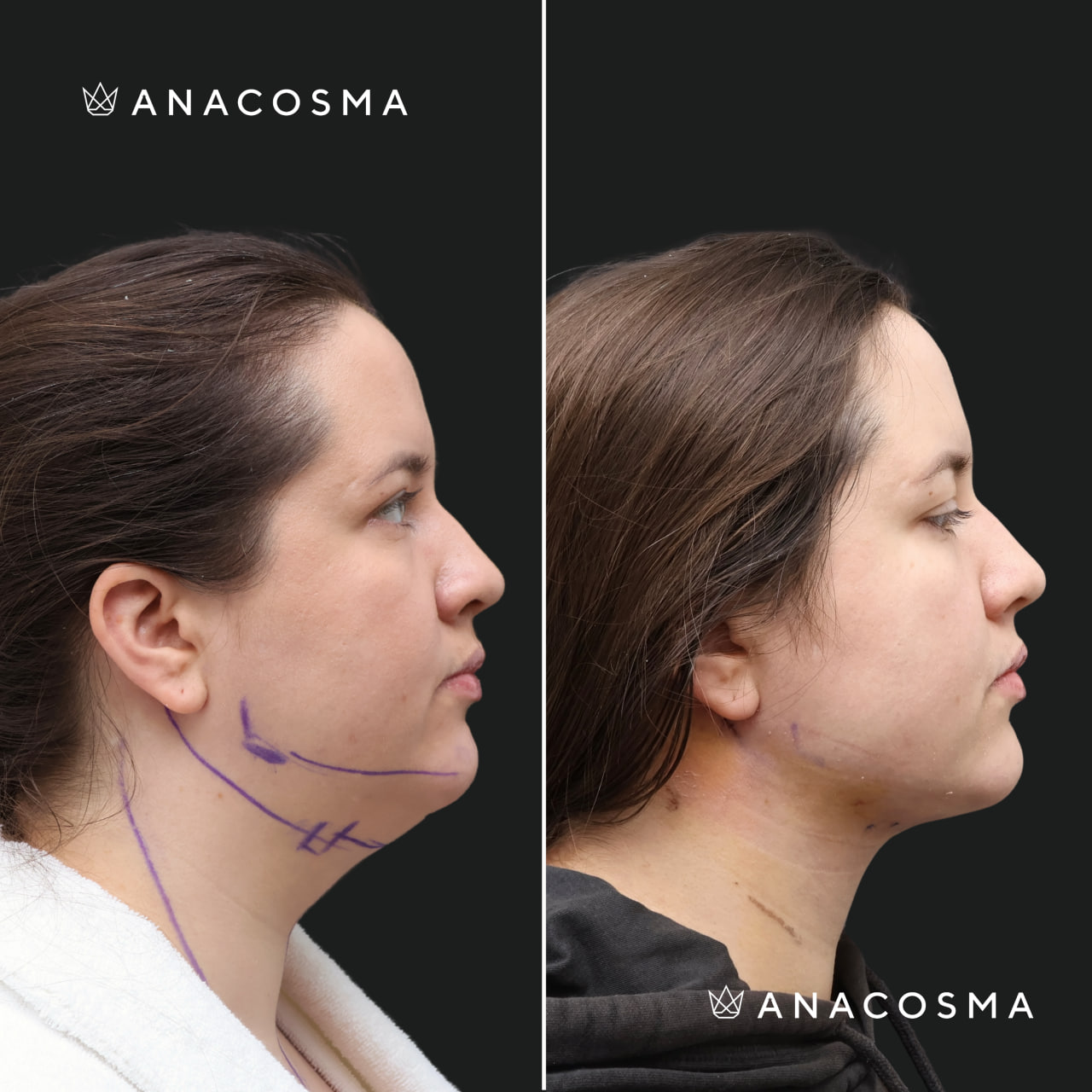 V-овал: чіткий кут молодості до і після - Фото 7