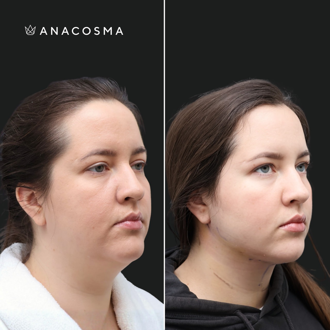 V-овал: чіткий кут молодості до і після - Фото 6