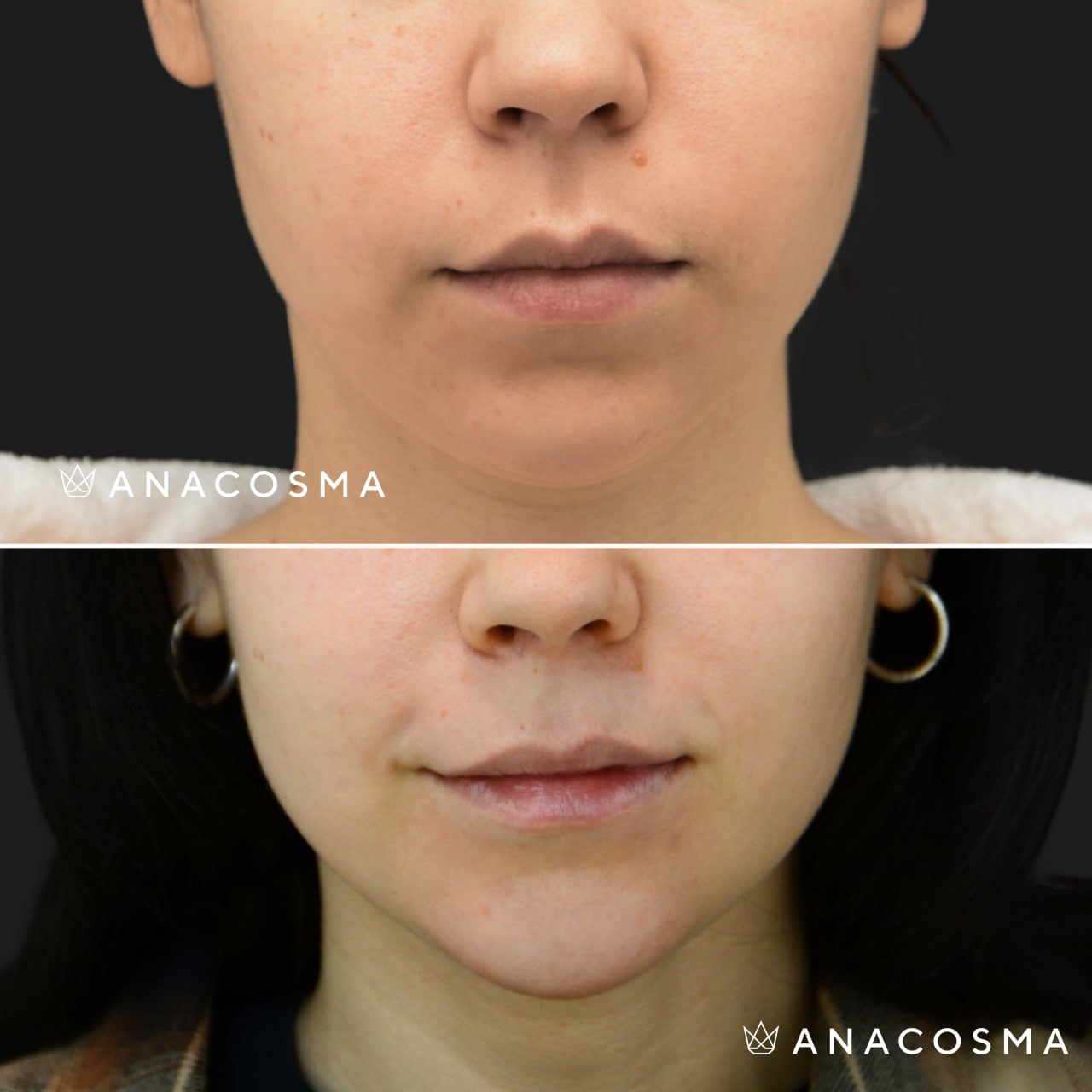 V-овал: чіткий кут молодості до і після - Фото 28