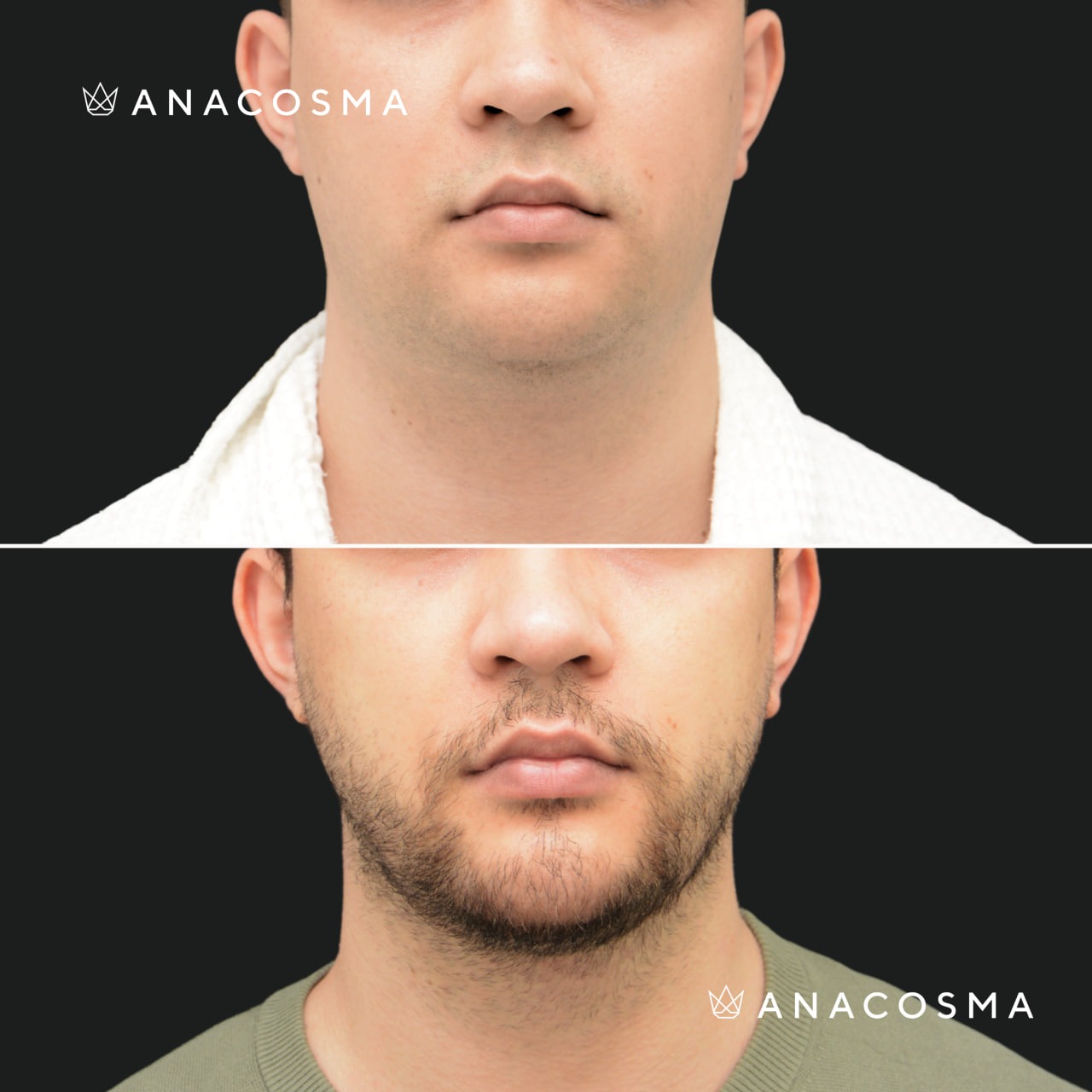 V-овал: чіткий кут молодості до і після - Фото 15