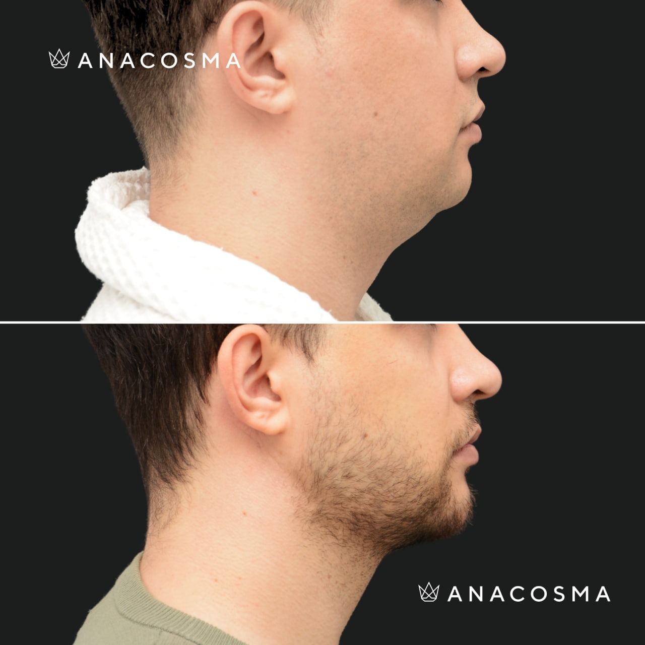 V-овал: чіткий кут молодості до і після - Фото 14