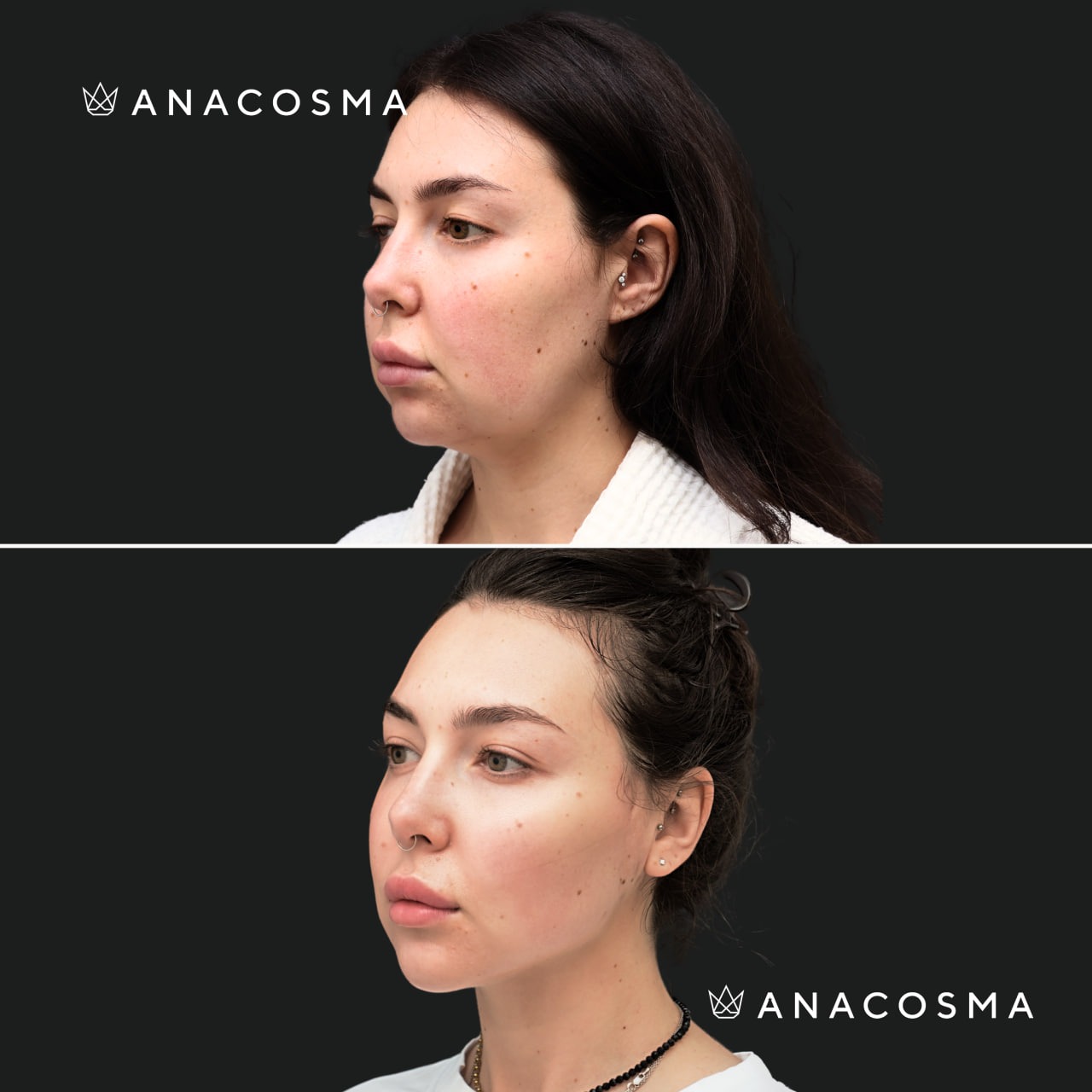 V-овал: чіткий кут молодості до і після - Фото 2