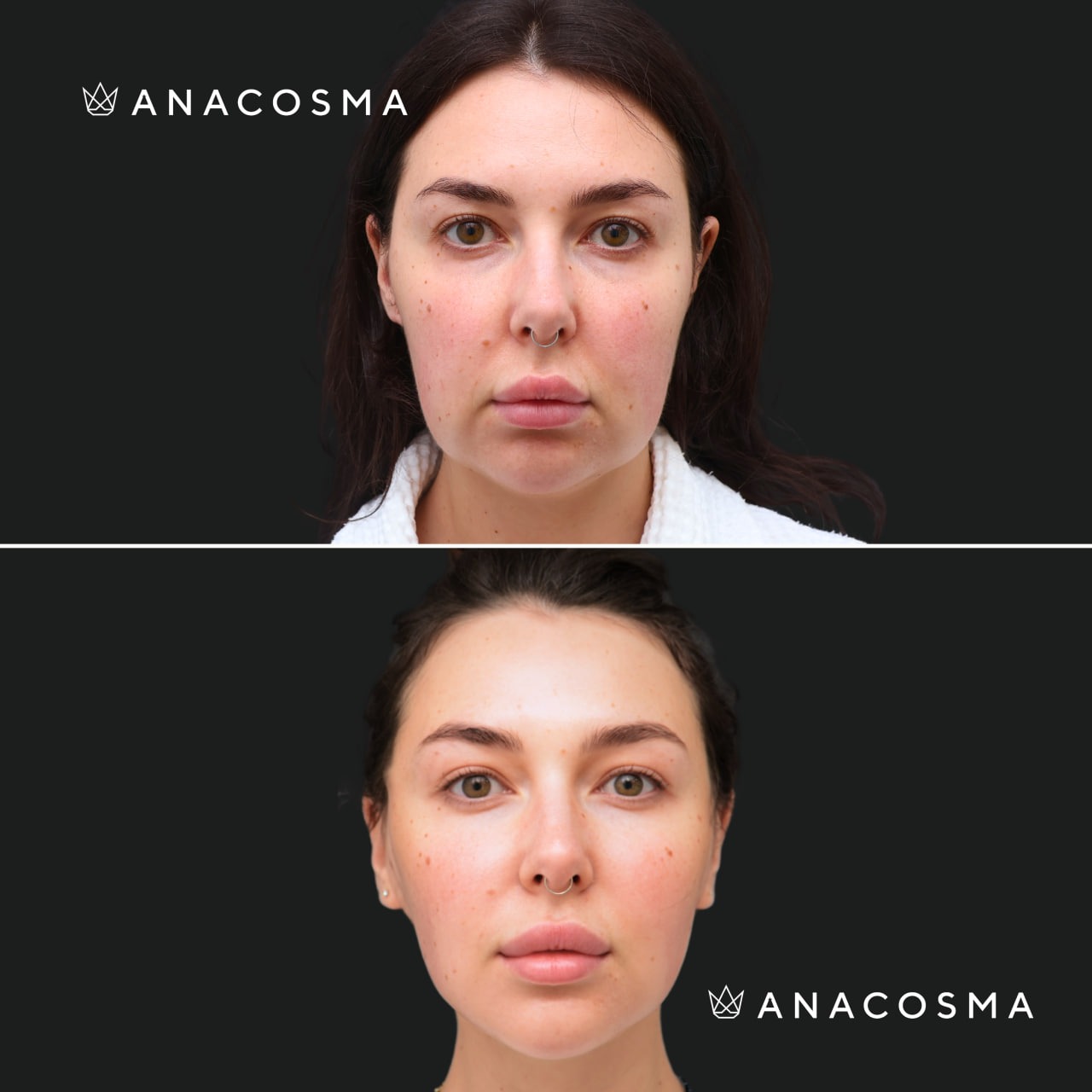 V-овал: чіткий кут молодості до і після - Фото 1