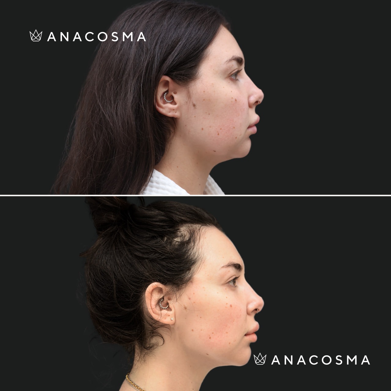 V-овал: чіткий кут молодості до і після - Фото 3