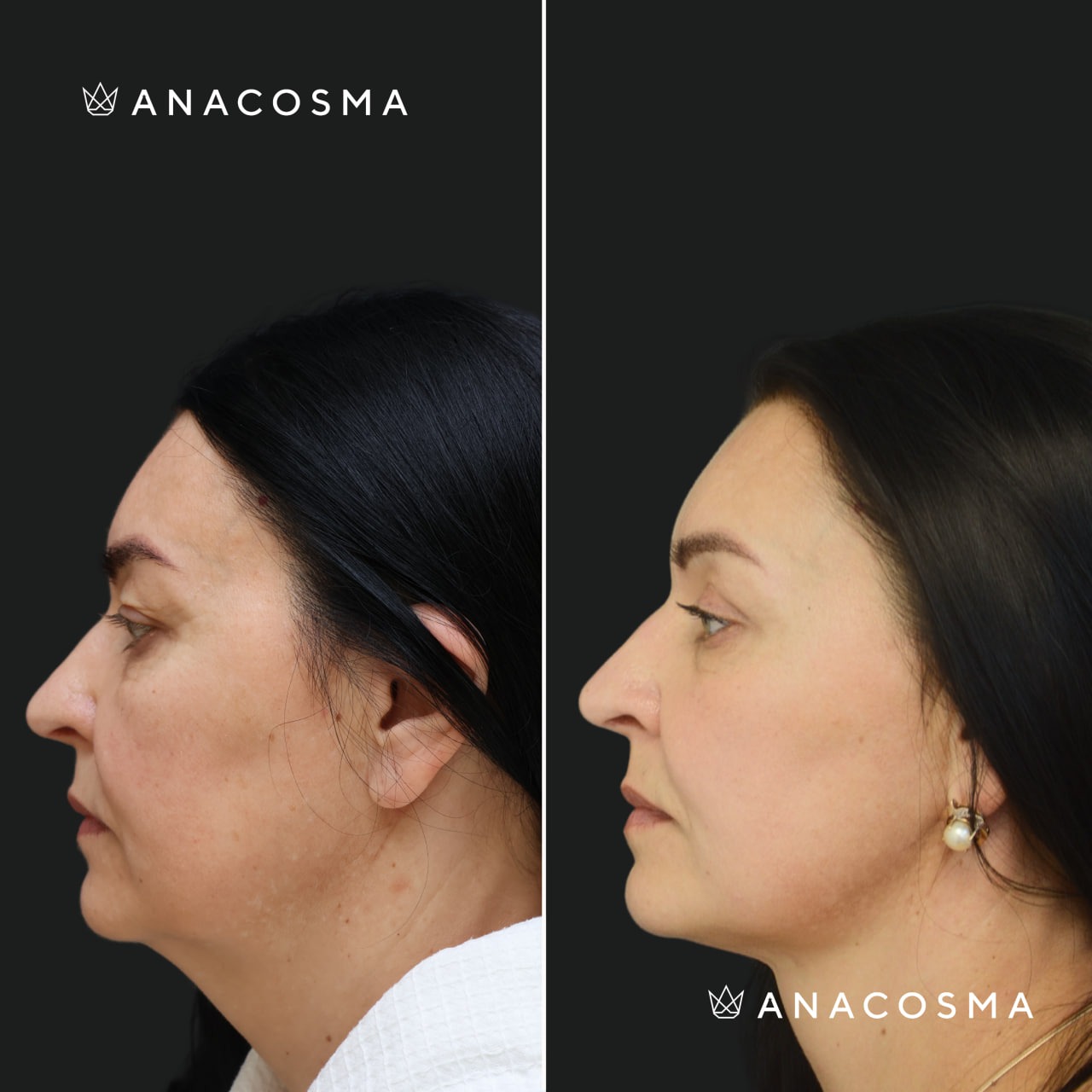 V-овал: чіткий кут молодості до і після - Фото 4