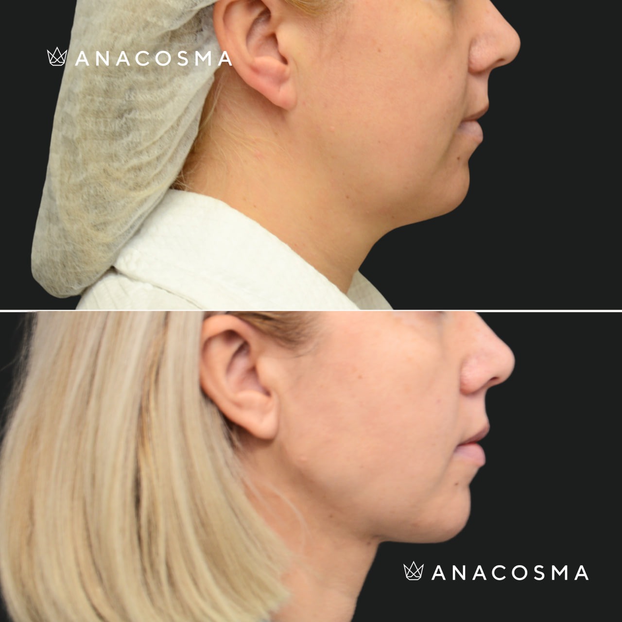 V-овал: чіткий кут молодості до і після - Фото 11