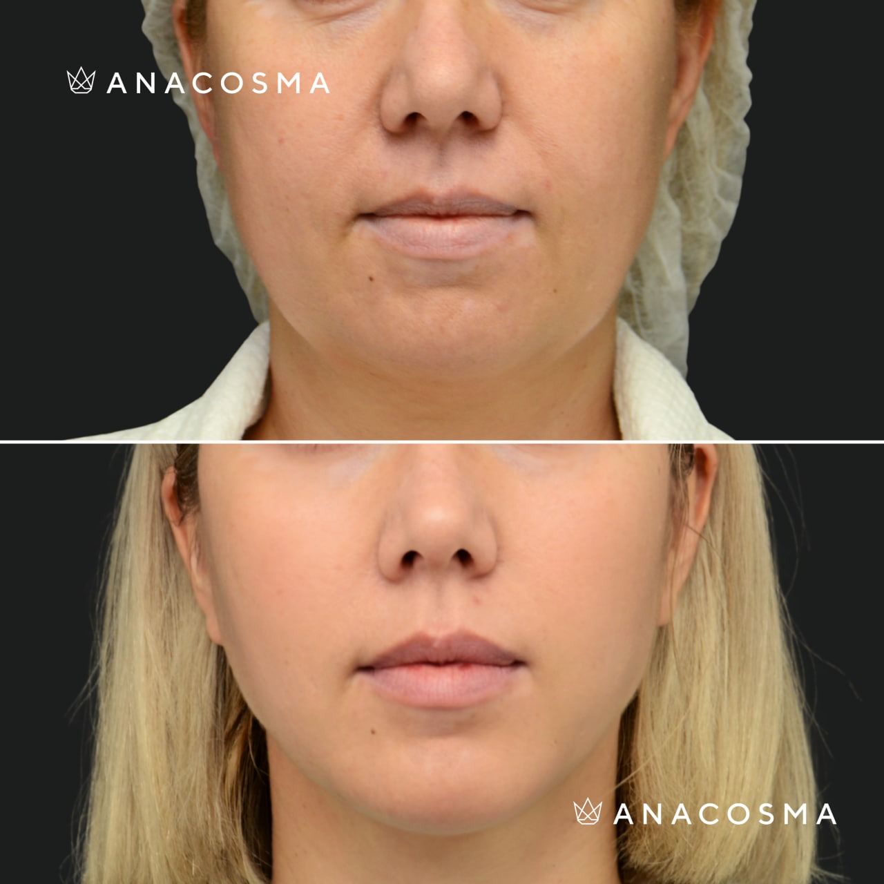 V-овал: чіткий кут молодості до і після - Фото 12