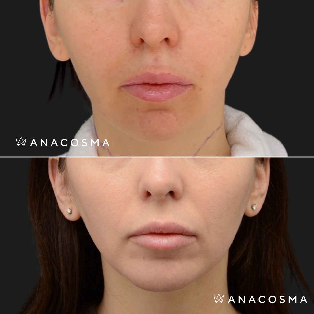 V-овал: чіткий кут молодості до і після - Фото 25