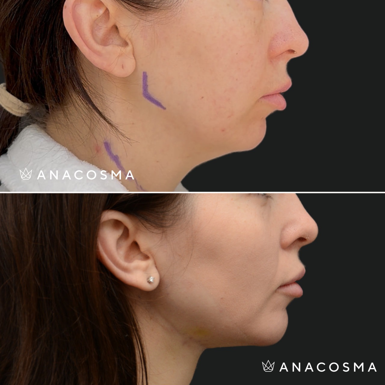 V-овал: чіткий кут молодості до і після - Фото 24