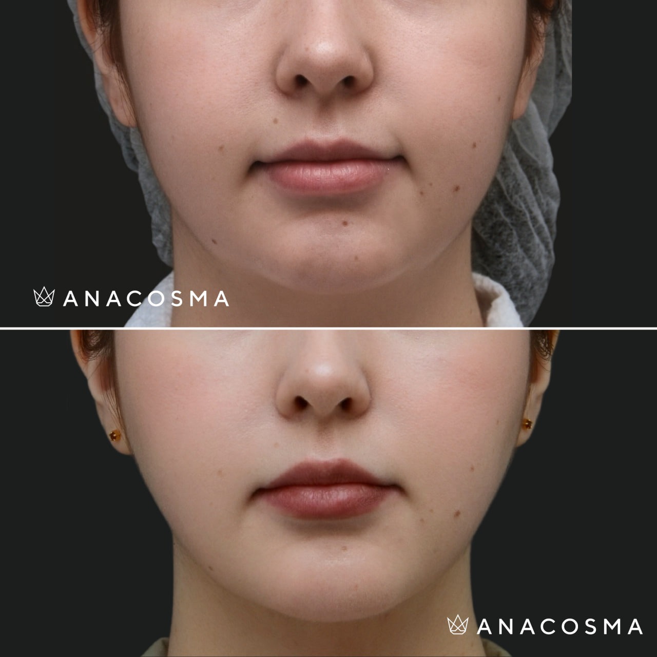 V-овал: чіткий кут молодості до і після - Фото 9