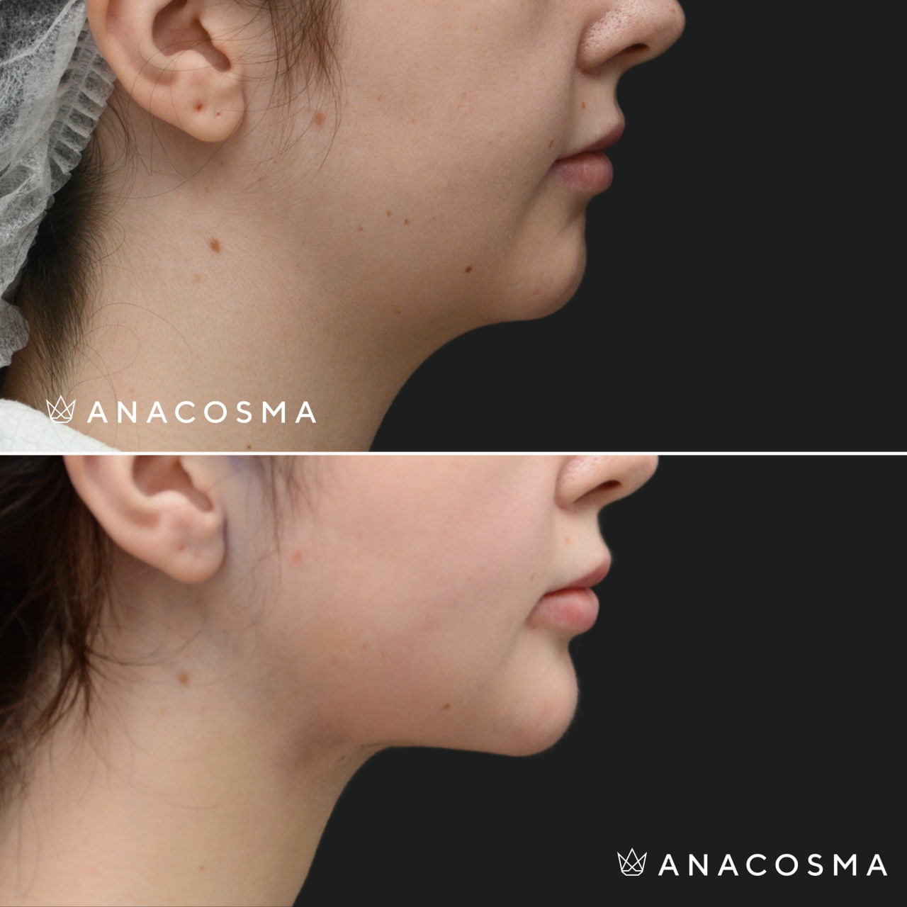 V-овал: чіткий кут молодості до і після - Фото 10