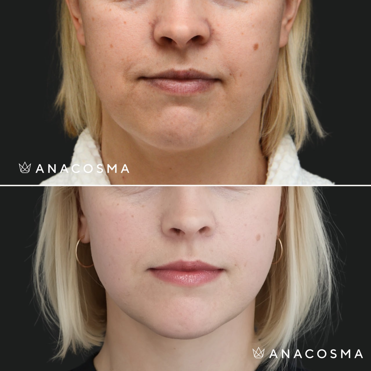 V-овал: чіткий кут молодості до і після - Фото 23