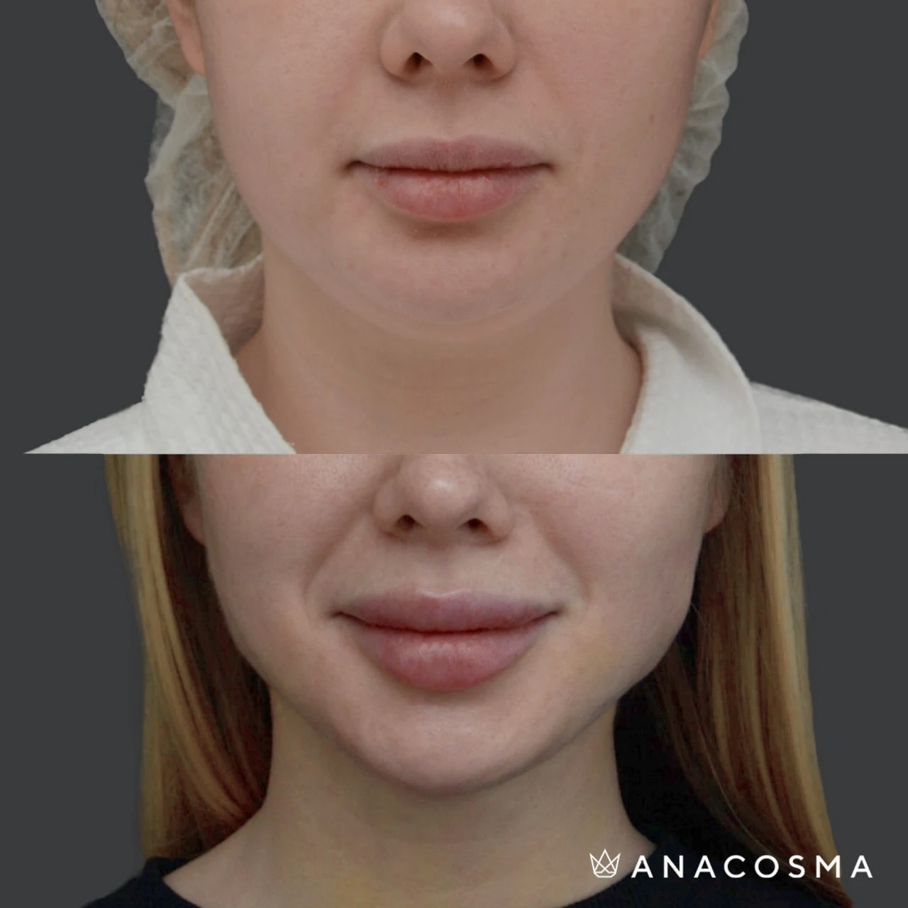 Ліпосакція підборіддя до і після - Фото 2