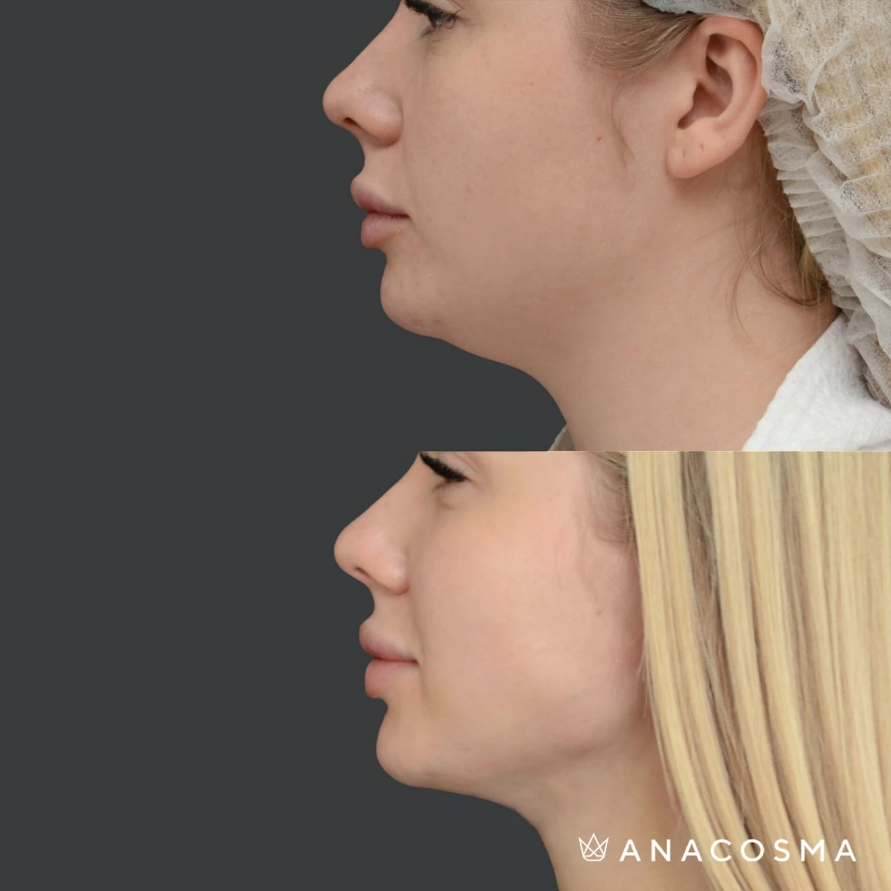 Ліпосакція підборіддя до і після - Фото 3