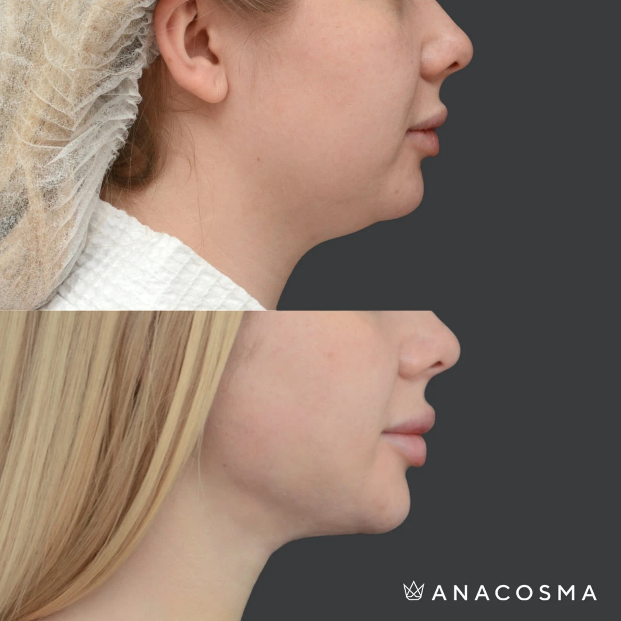 Ліпосакція підборіддя до і після - Фото 1