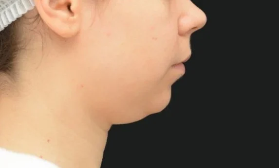 Ліпосакція підборіддя - Фото До