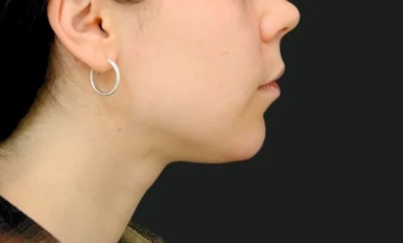 Ліпосакція підборіддя - Фото Після